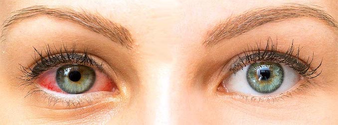 Síntomas y tratamiento del ojo seco