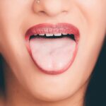 Cómo tratar la lengua blanca de forma natural