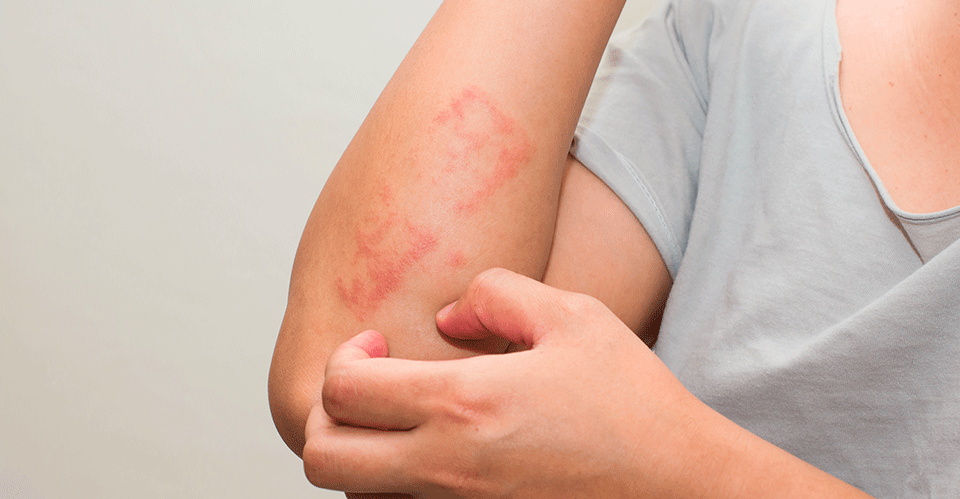 Cómo prevenir y tratar los eccemas de la piel